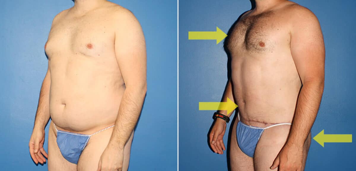 Torso Tuck Before and After Photos in New York, NY, Patient 15903