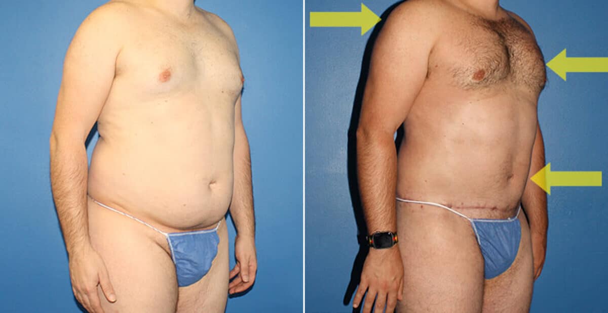 Torso Tuck Before and After Photos in New York, NY, Patient 15903