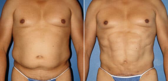 Torso Tuck Before and After Photos in New York, NY, Patient 15928