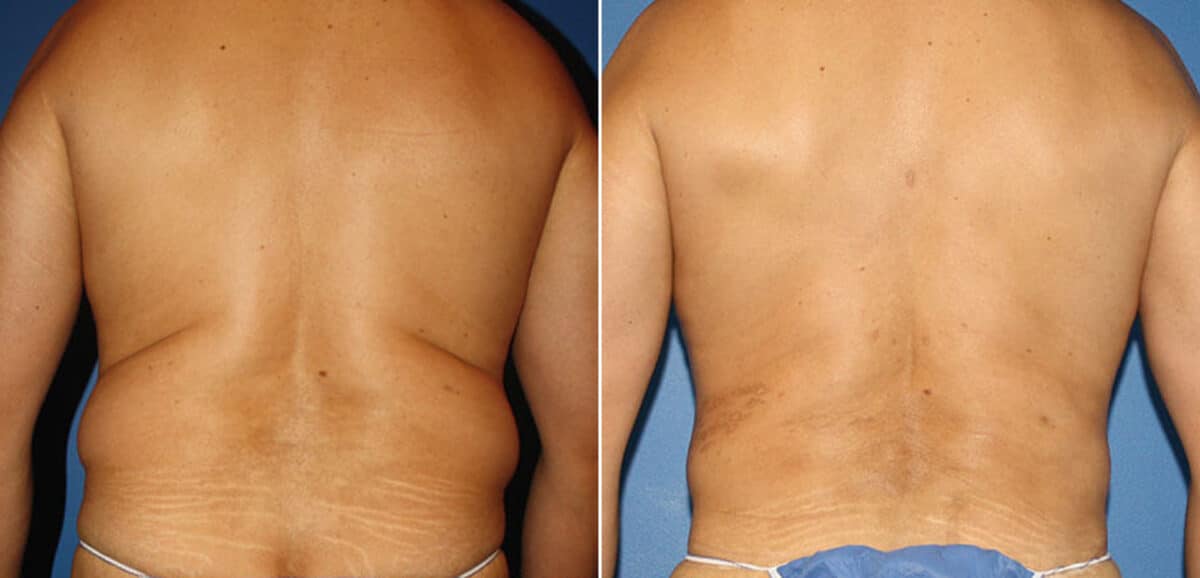 Torso Tuck Before and After Photos in New York, NY, Patient 15928