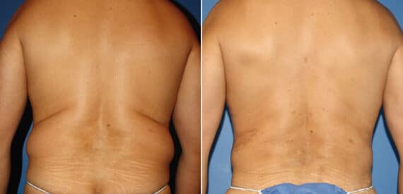 Torso Tuck Before and After Photos in New York, NY, Patient 15928