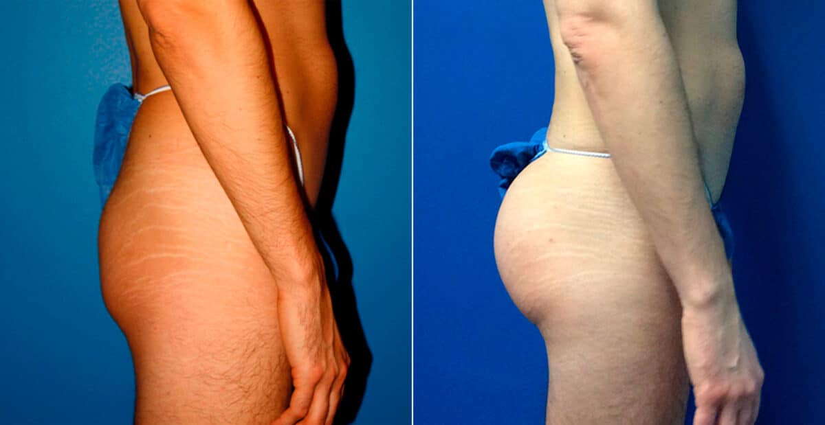 Gluteal Augmentation Before and After Photos in New York, NY, Patient 16779