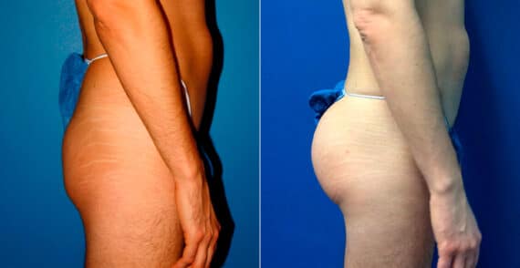 Gluteal Augmentation Before and After Photos in New York, NY, Patient 16779