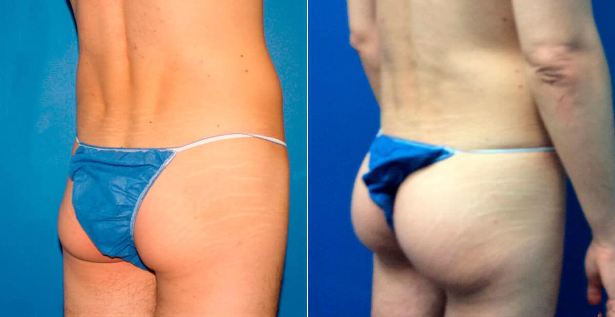 Gluteal Augmentation Before and After Photos in New York, NY, Patient 16779
