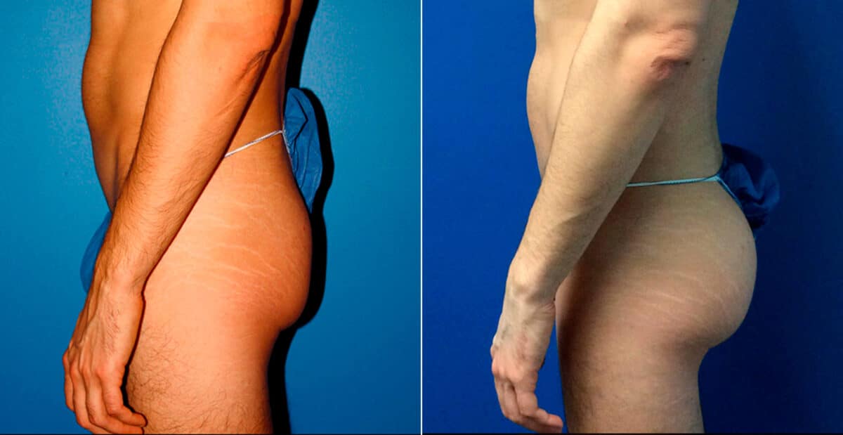 Gluteal Augmentation Before and After Photos in New York, NY, Patient 16779