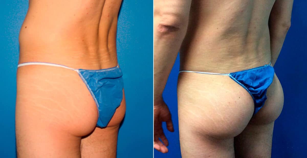 Gluteal Augmentation Before and After Photos in New York, NY, Patient 16779