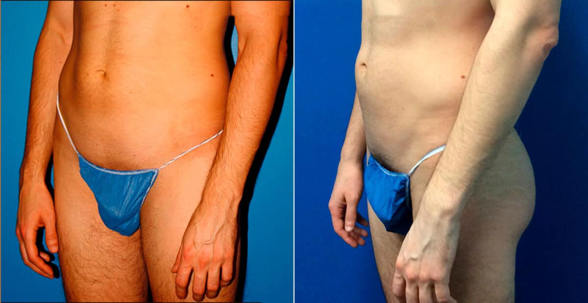 Gluteal Augmentation Before and After Photos in New York, NY, Patient 16779