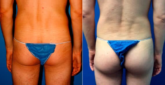 Gluteal Augmentation Before and After Photos in New York, NY, Patient 16779