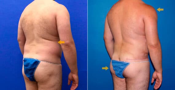Body Banking Before and After Photos in New York, NY, Patient 16799