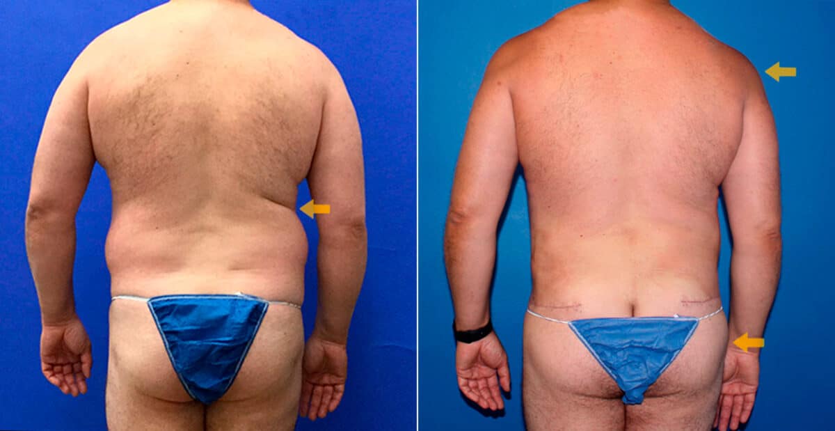 Body Banking Before and After Photos in New York, NY, Patient 16799