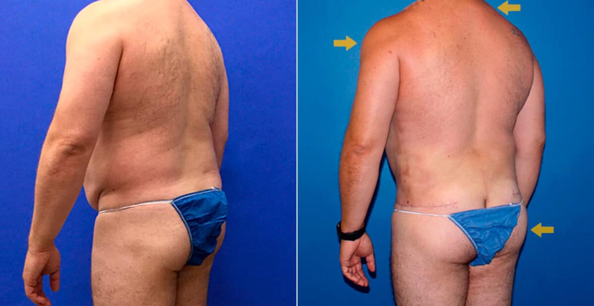 Body Banking Before and After Photos in New York, NY, Patient 16799
