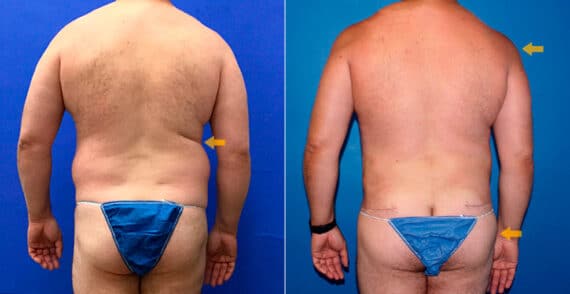 Body Banking Before and After Photos in New York, NY, Patient 16799