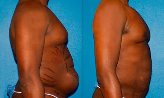 Liposuction Before and After Photos in New York, NY, Patient 16888