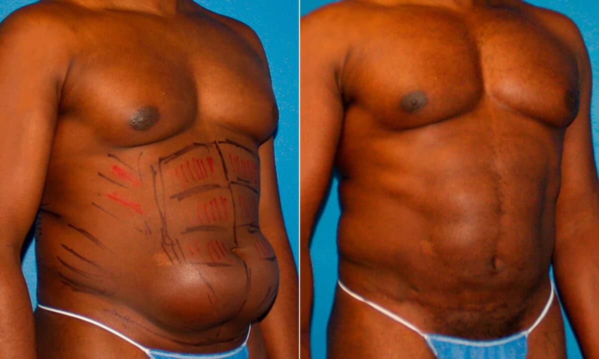 Liposuction Before and After Photos in New York, NY, Patient 16888