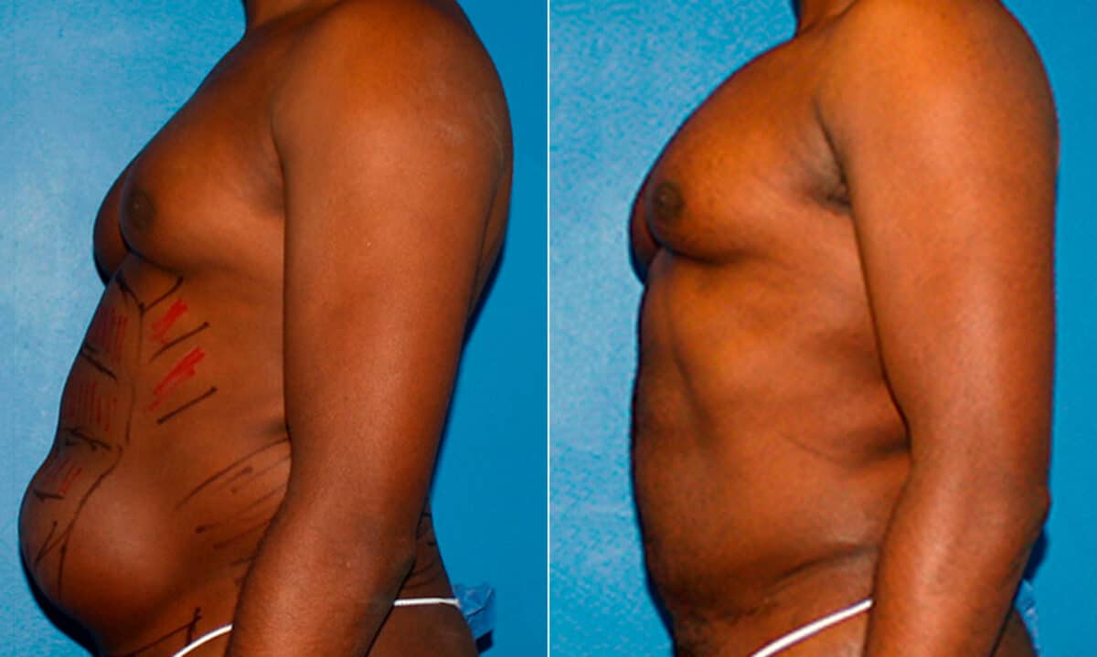 Liposuction Before and After Photos in New York, NY, Patient 16888