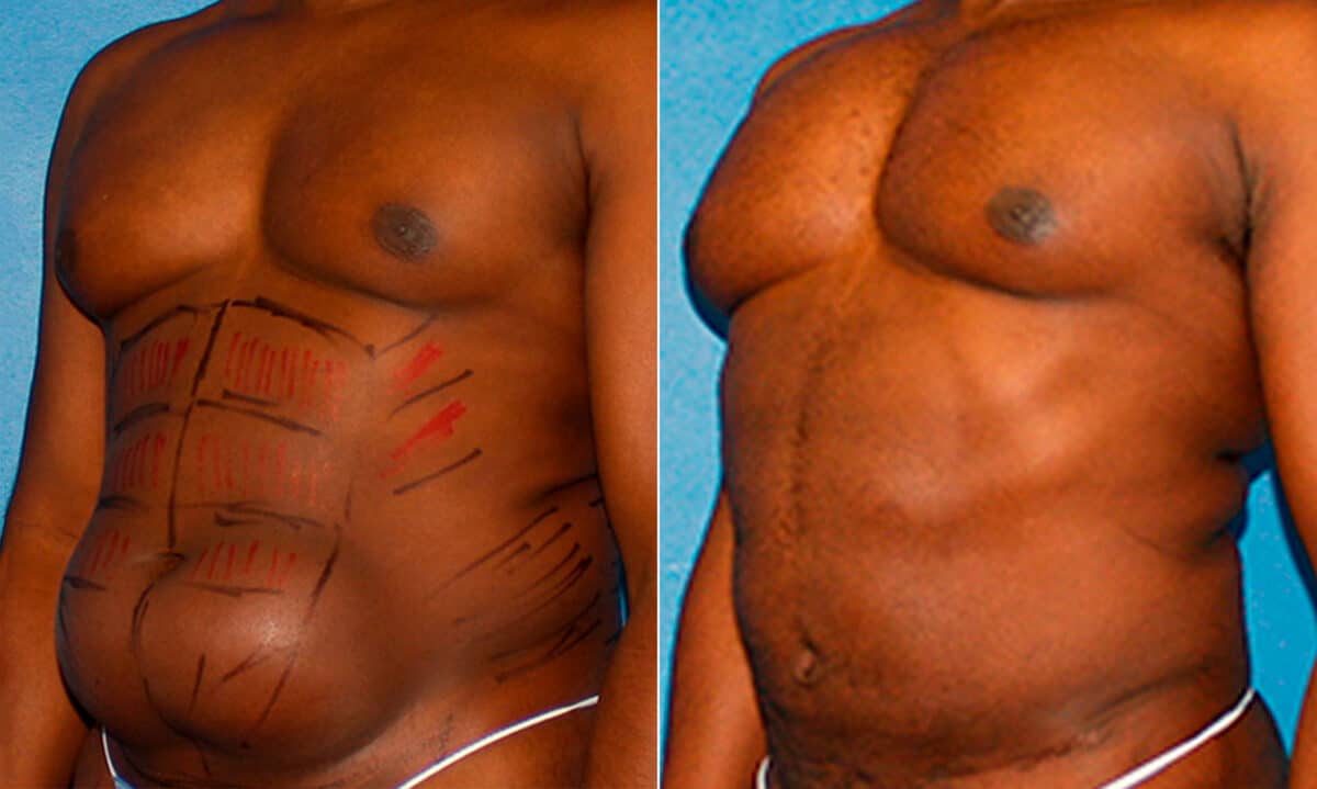 Liposuction Before and After Photos in New York, NY, Patient 16888
