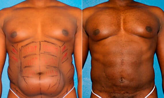 Liposuction Before and After Photos in New York, NY, Patient 16888