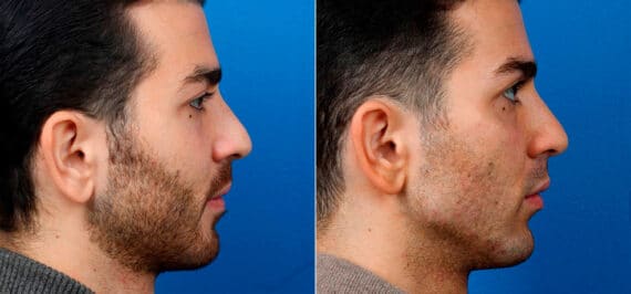 Male Model Make Over Before and After Photos in New York, NY, Patient 16865