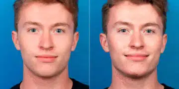 Male Model Make Over Before and After Photos in New York, NY, Patient 16922