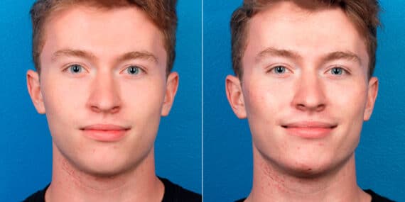 Male Model Make Over Before and After Photos in New York, NY, Patient 16922