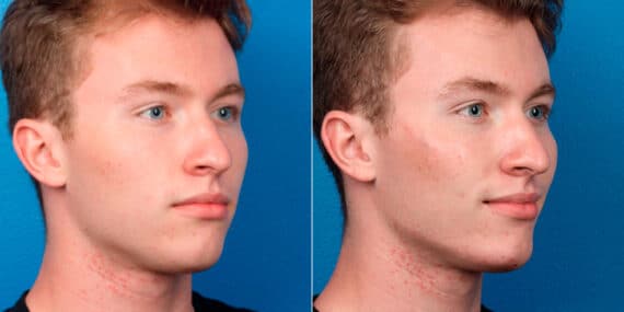 Male Model Make Over Before and After Photos in New York, NY, Patient 16922