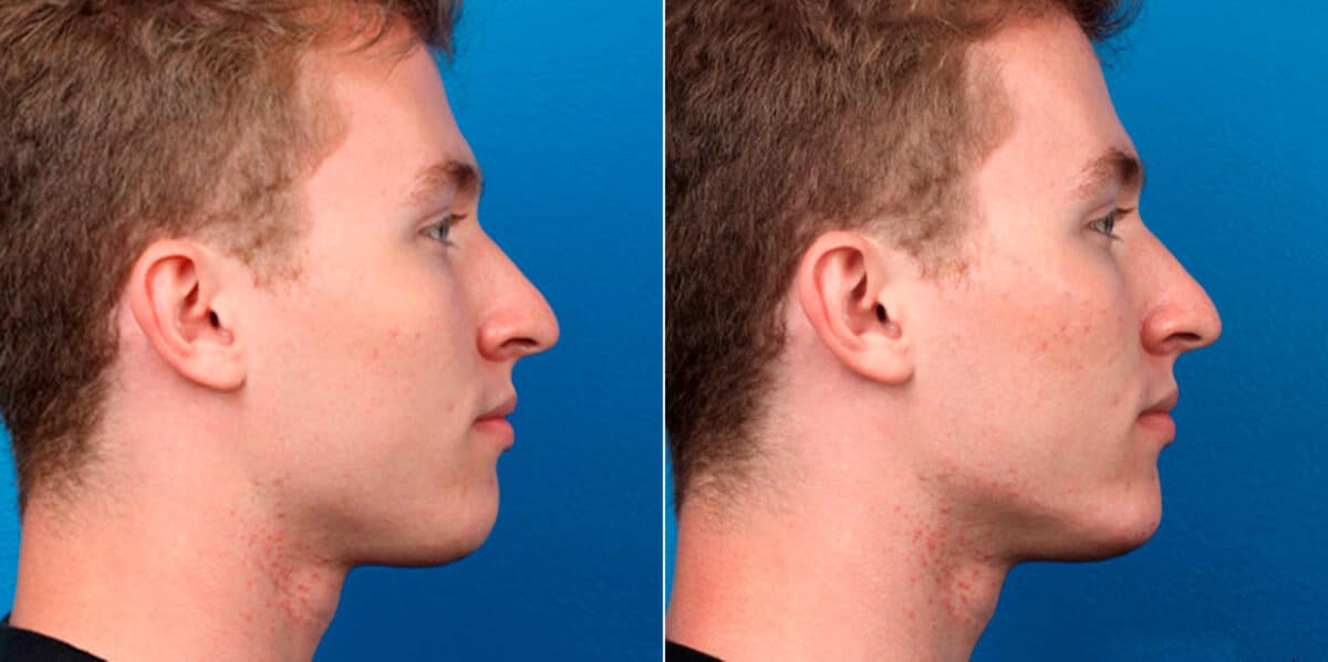Male Model Make Over Before and After Photos in New York, NY, Patient 16922