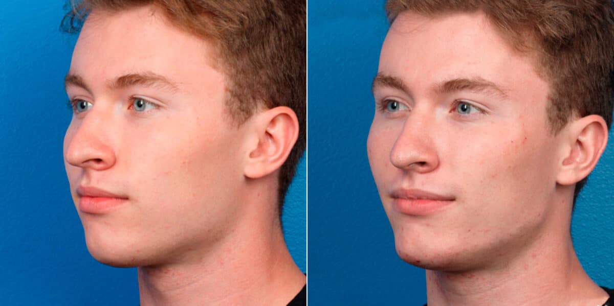 Male Model Make Over Before and After Photos in New York, NY, Patient 16922