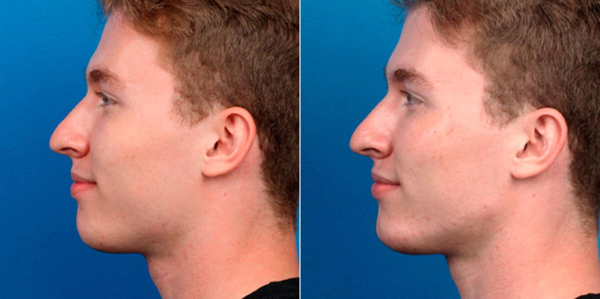 Male Model Make Over Before and After Photos in New York, NY, Patient 16922