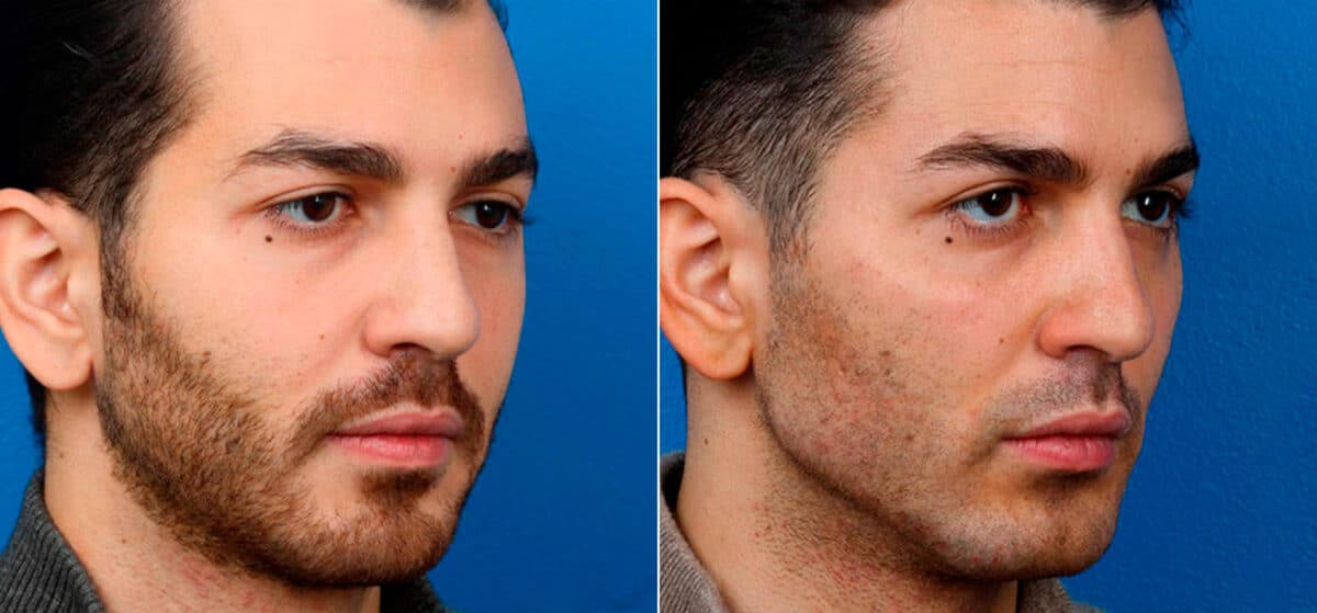 Male Model Make Over Before and After Photos in New York, NY, Patient 16865
