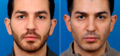 Male Model Make Over Before and After Photos in New York, NY, Patient 16865