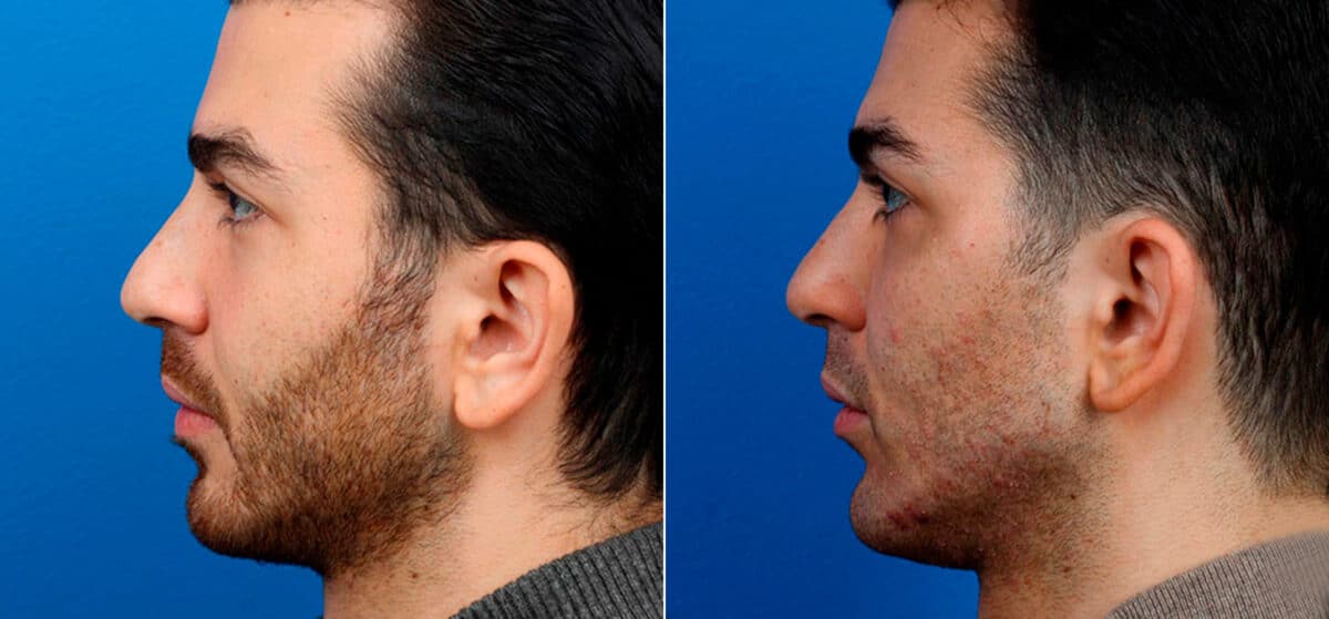Male Model Make Over Before and After Photos in New York, NY, Patient 16865
