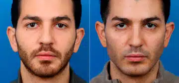 Male Model Make Over Before and After Photos in New York, NY, Patient 16865