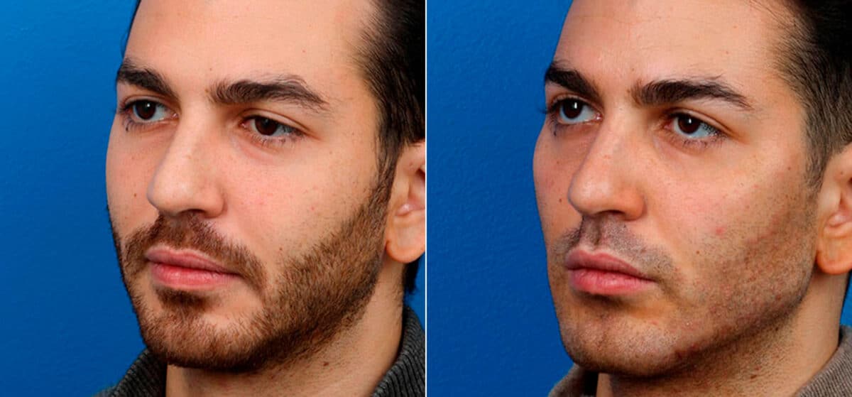Male Model Make Over Before and After Photos in New York, NY, Patient 16865