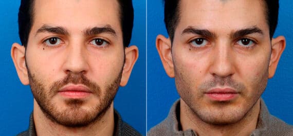 Male Model Make Over Before and After Photos in New York, NY, Patient 16865