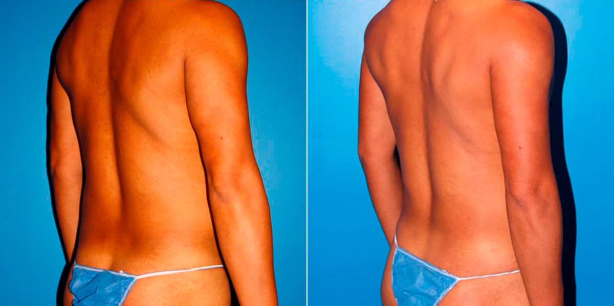Body Banking Before and After Photos in New York, NY, Patient 16970