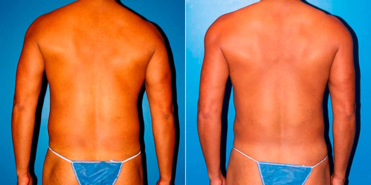 Body Banking Before and After Photos in New York, NY, Patient 16970