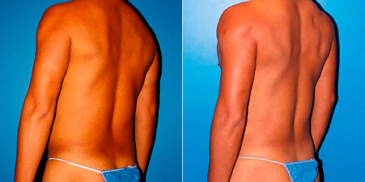 Body Banking Before and After Photos in New York, NY, Patient 16970