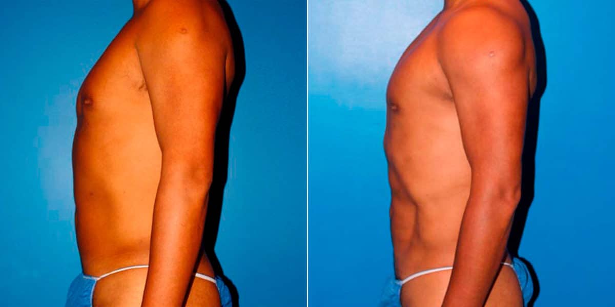 Body Banking Before and After Photos in New York, NY, Patient 16970
