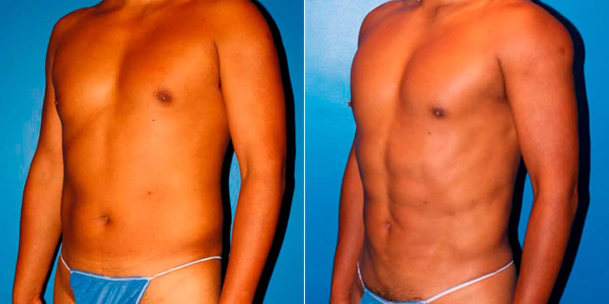 Body Banking Before and After Photos in New York, NY, Patient 16970