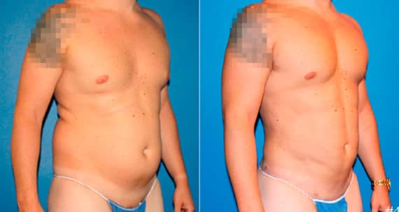 Body Banking Before and After Photos in New York, NY, Patient 17242