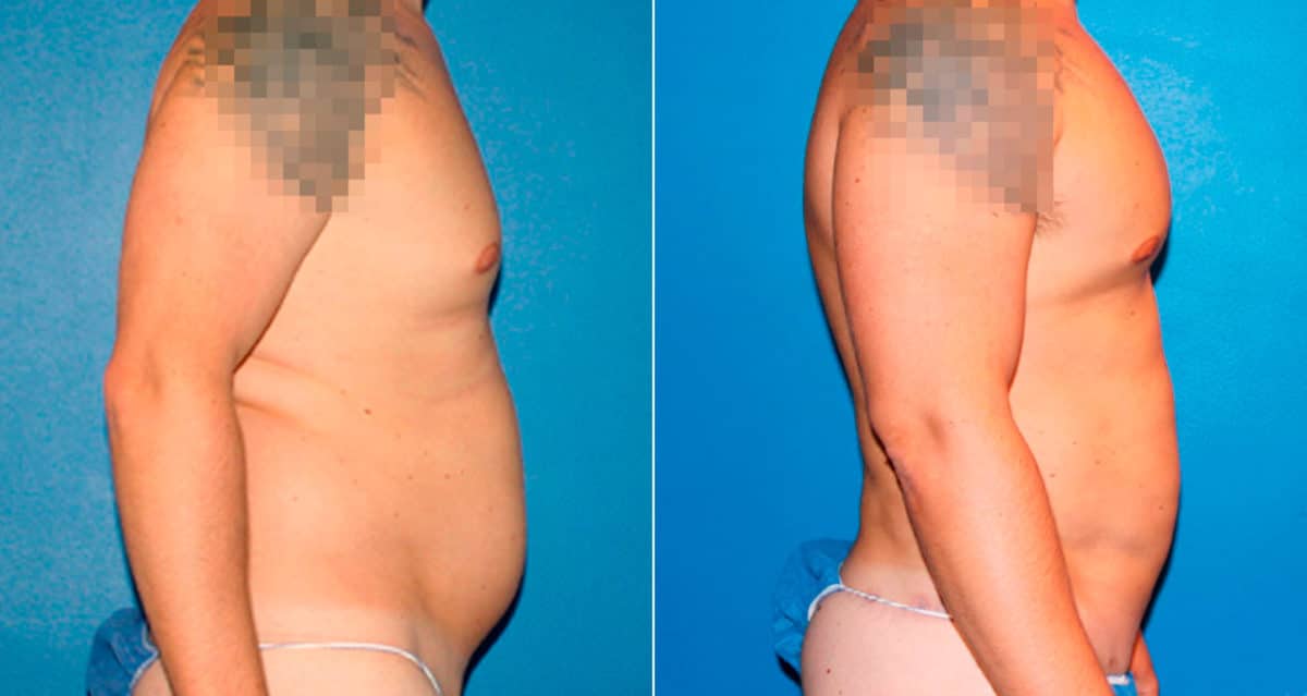 Body Banking Before and After Photos in New York, NY, Patient 17242