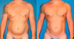 Body Banking Before and After Photos in New York, NY, Patient 17242