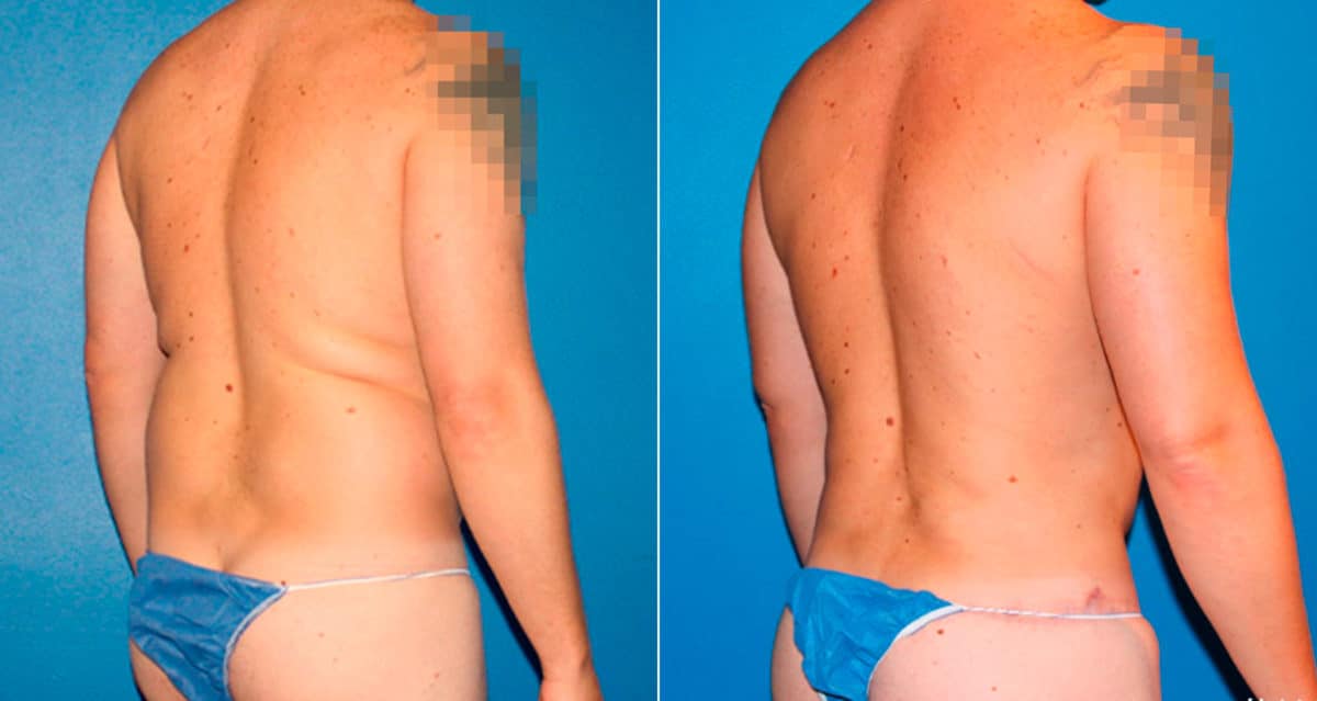 Body Banking Before and After Photos in New York, NY, Patient 17242