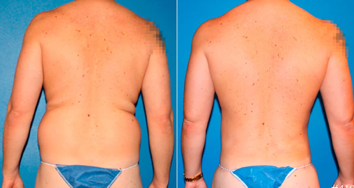 Body Banking Before and After Photos in New York, NY, Patient 17242
