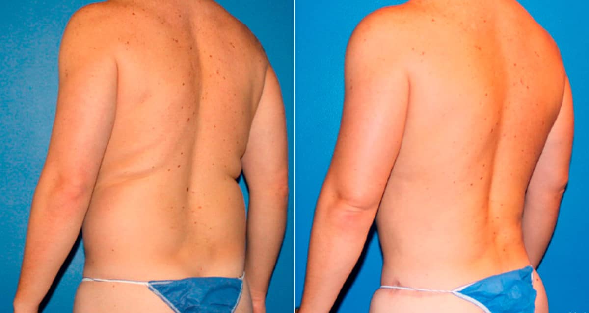 Body Banking Before and After Photos in New York, NY, Patient 17242