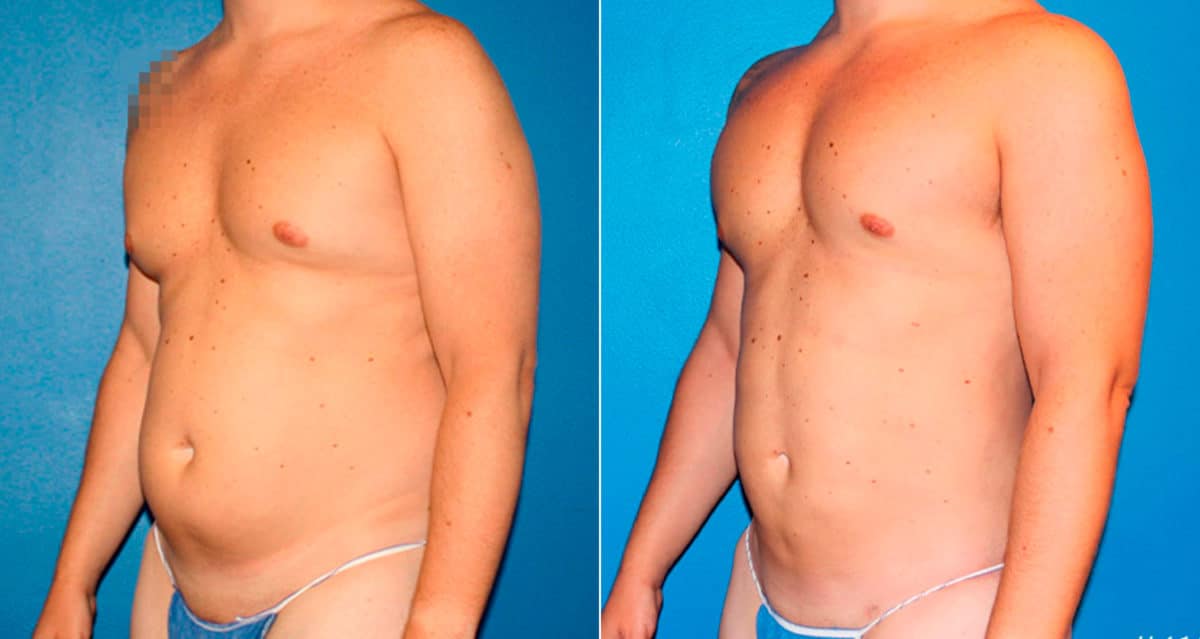Body Banking Before and After Photos in New York, NY, Patient 17242