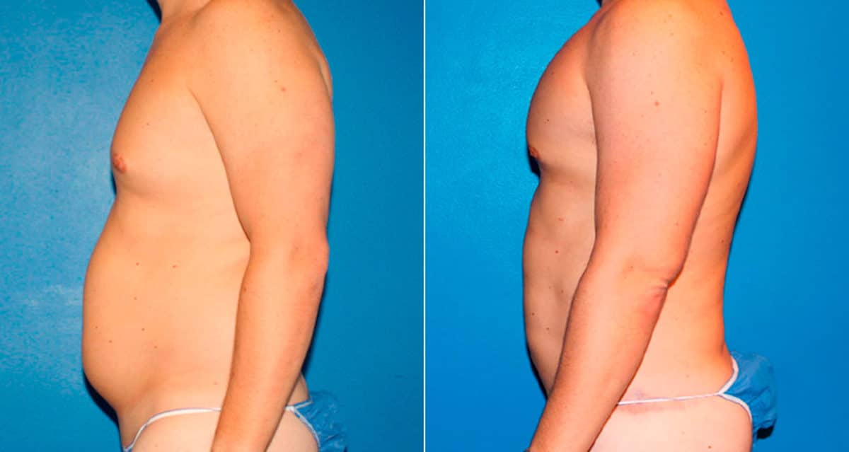 Body Banking Before and After Photos in New York, NY, Patient 17242