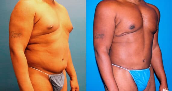 Liposuction Before and After Photos in New York, NY, Patient 17276