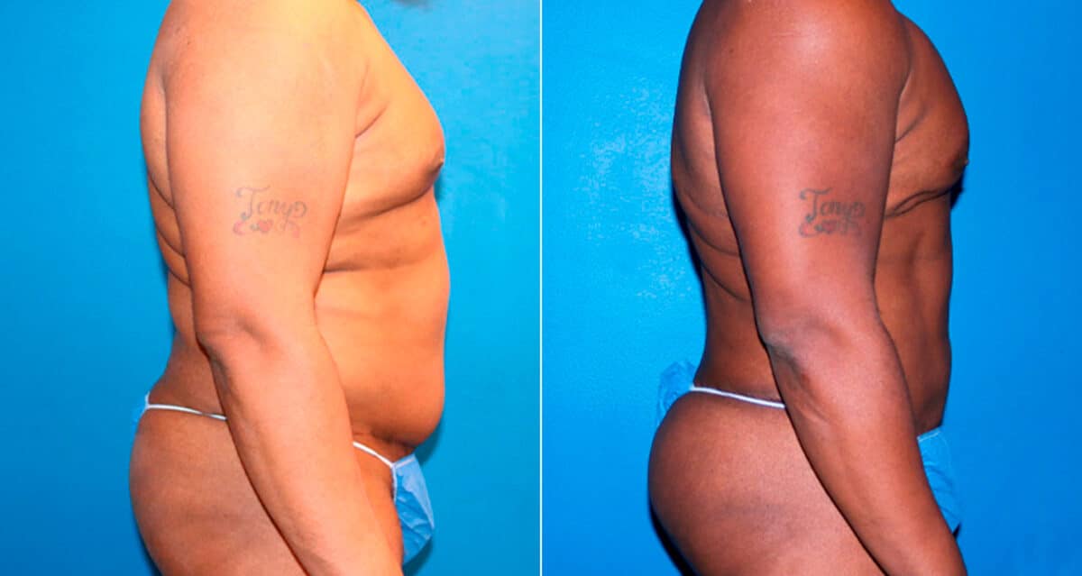 Body Banking Before and After Photos in New York, NY, Patient 17276