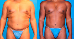 Liposuction Before and After Photos in New York, NY, Patient 17276